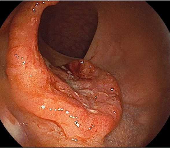 大腸がんの症状