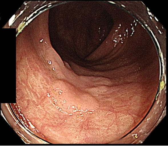 大腸がんの症状