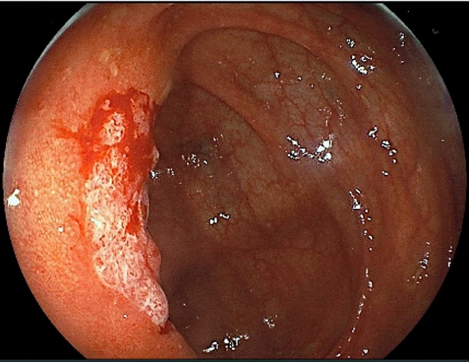 感染性腸炎