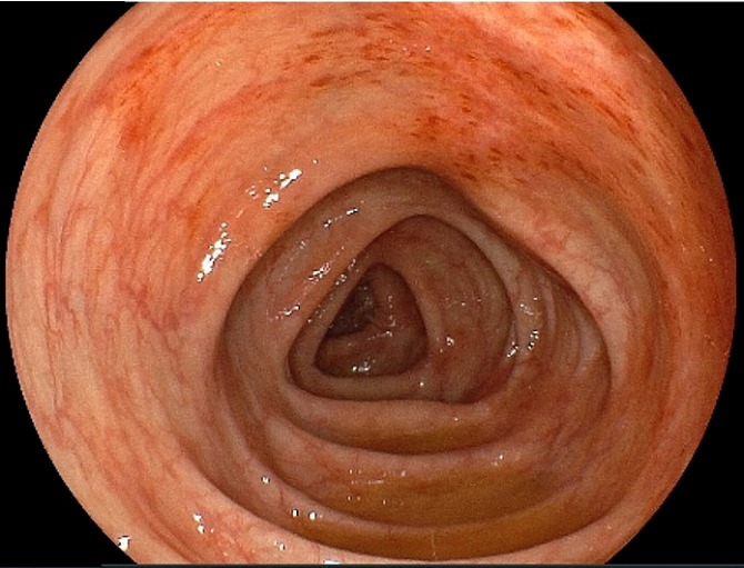 虚血性腸炎