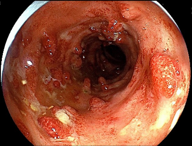 潰瘍性大腸炎