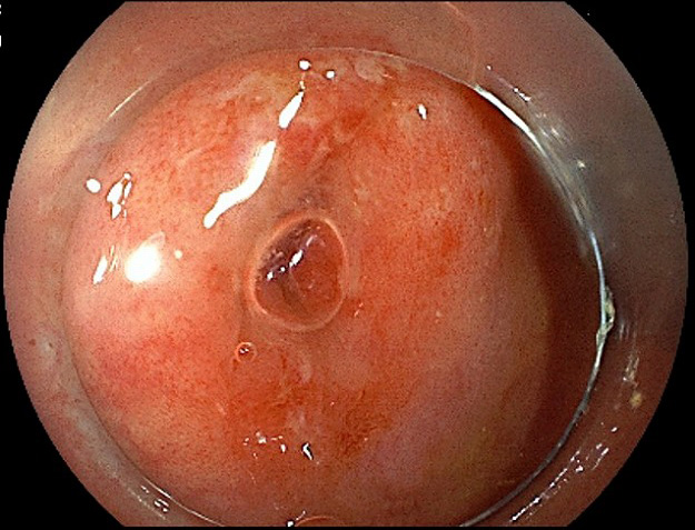 大腸憩室炎