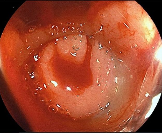 大腸憩室出血