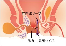 肛門ポリープとは