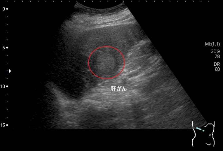肝臓がん（エコー）