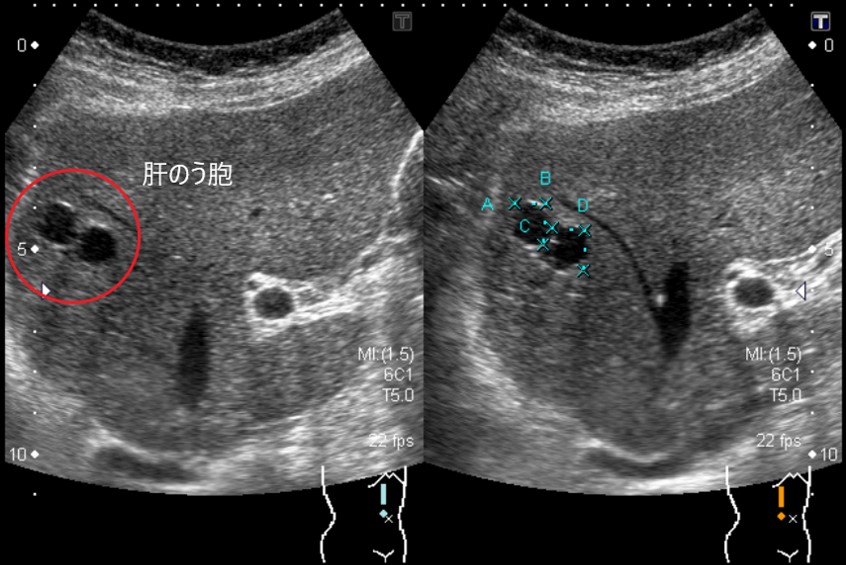 肝血管腫（エコー）