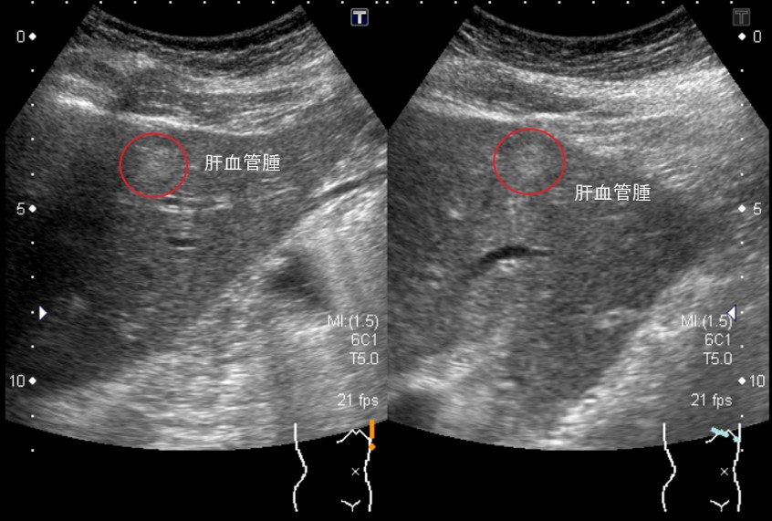 肝のう胞（エコー）