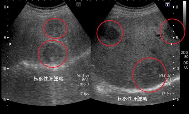 転移性肝腫瘍（エコー）