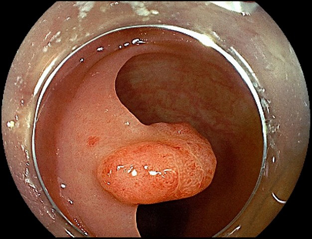 大腸ポリープの内視鏡的切除手術