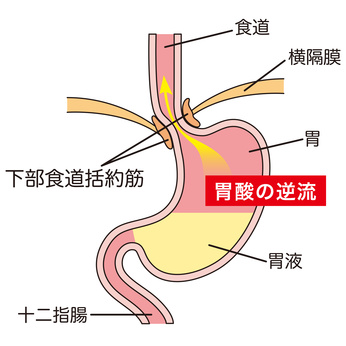 逆流性食道炎